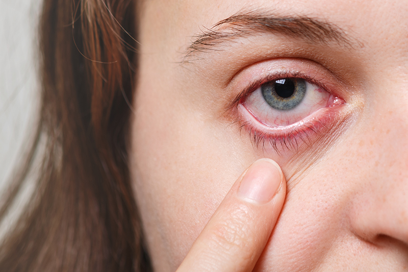 A woman pinches the lower lid of her eye to show redness